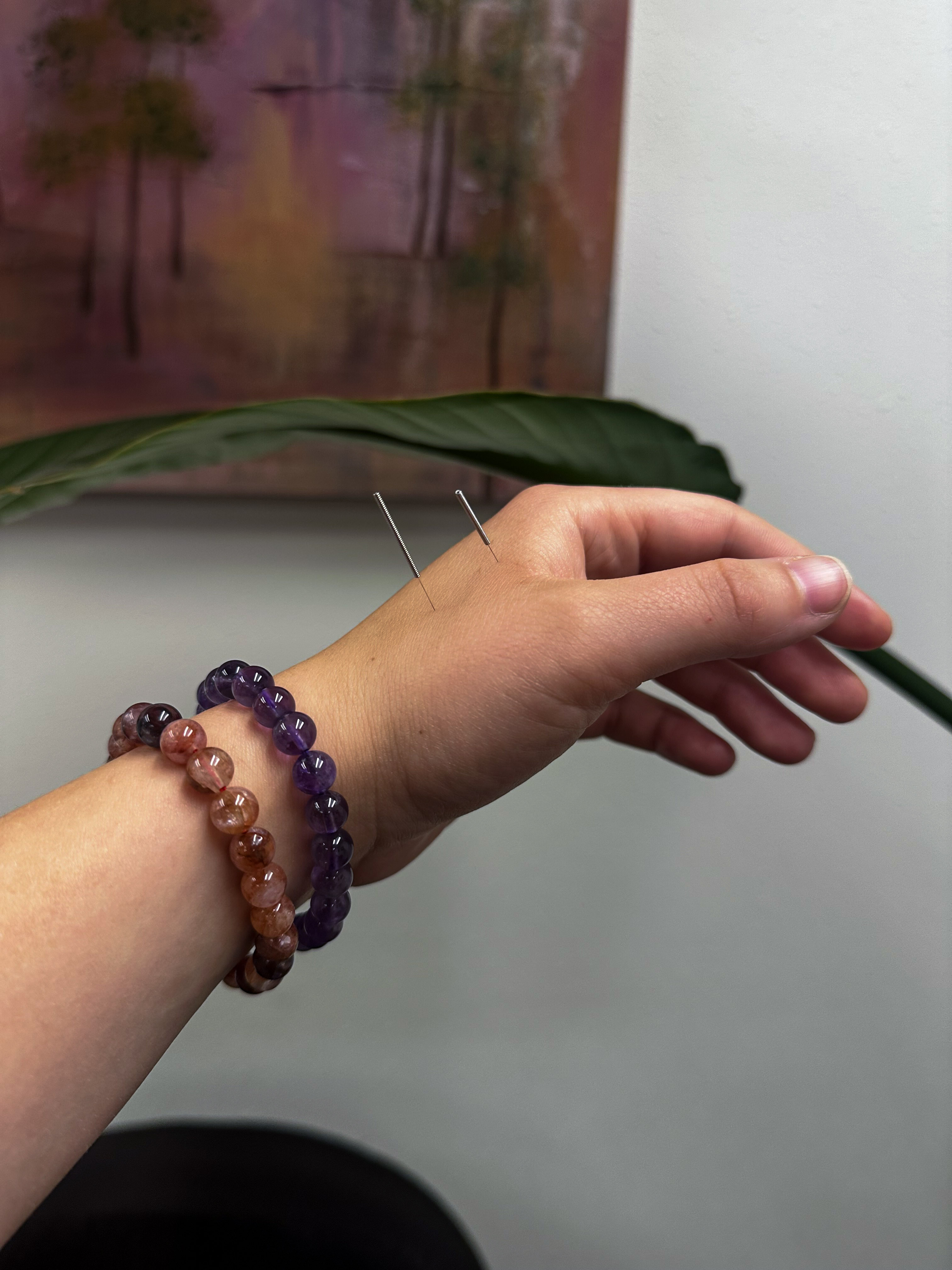 Acupuncture needles