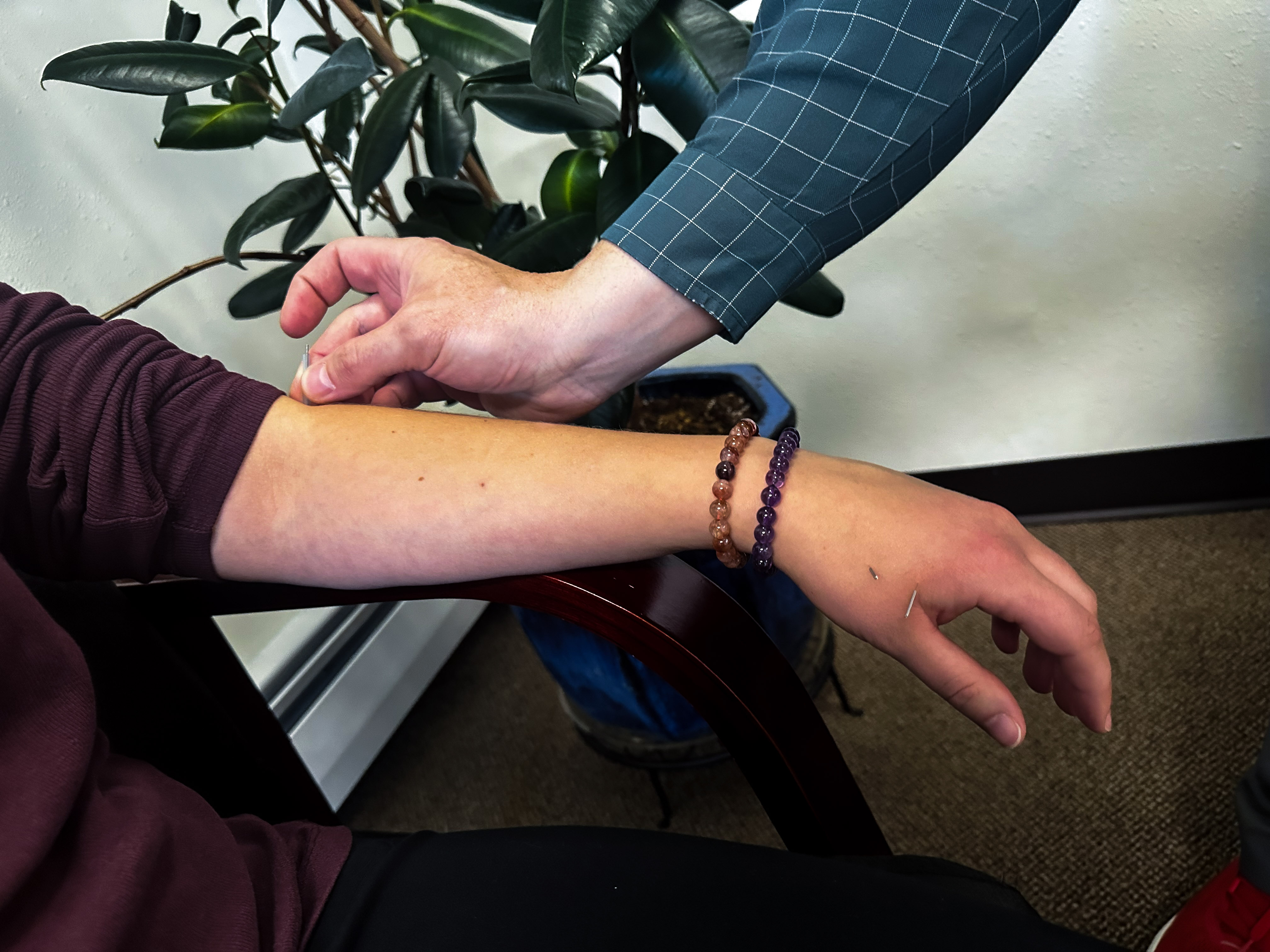Acupuncture treatment